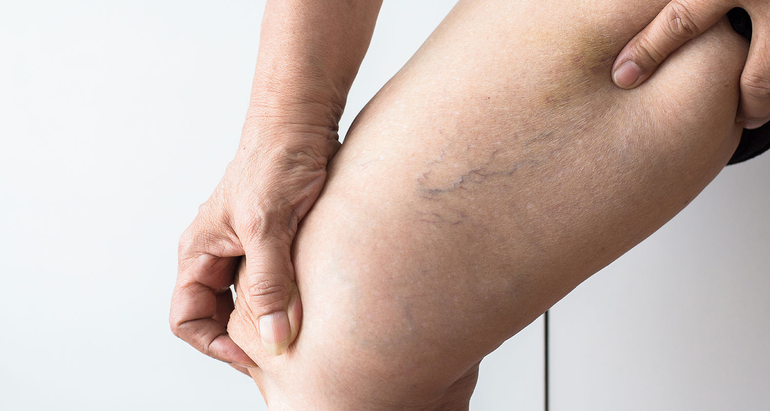 How Sublime MediSpa Can Help You Combat Spider and Varicose Veins