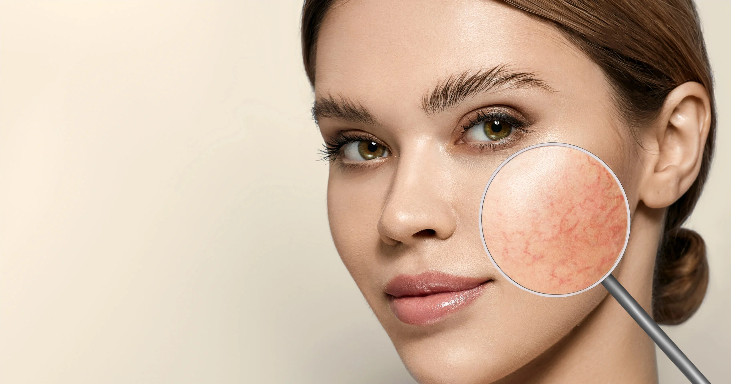 Rosacea and Sensitive Skin