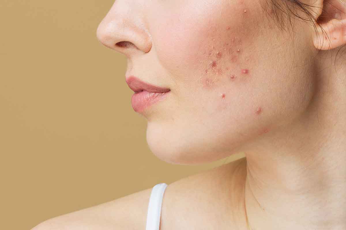 Hormonal acne