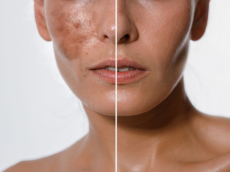 Why Chemical Peels Are a Game-Changer