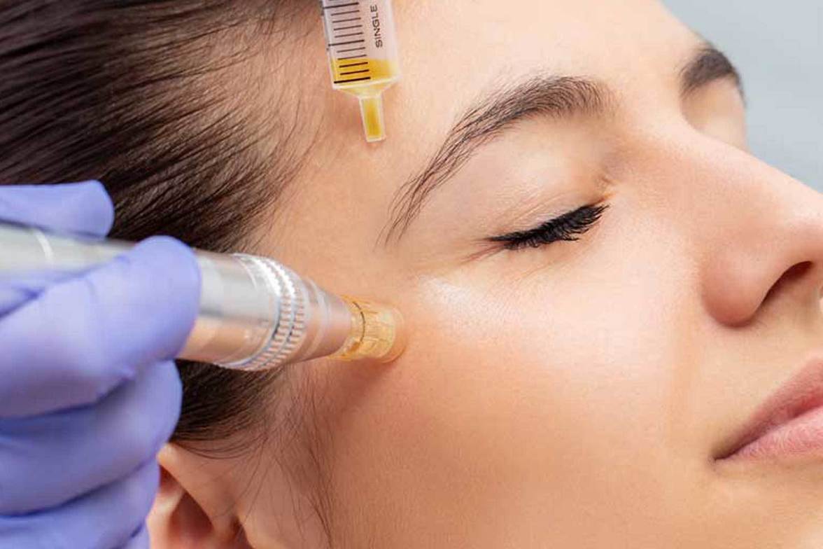 Microneedling with PRP