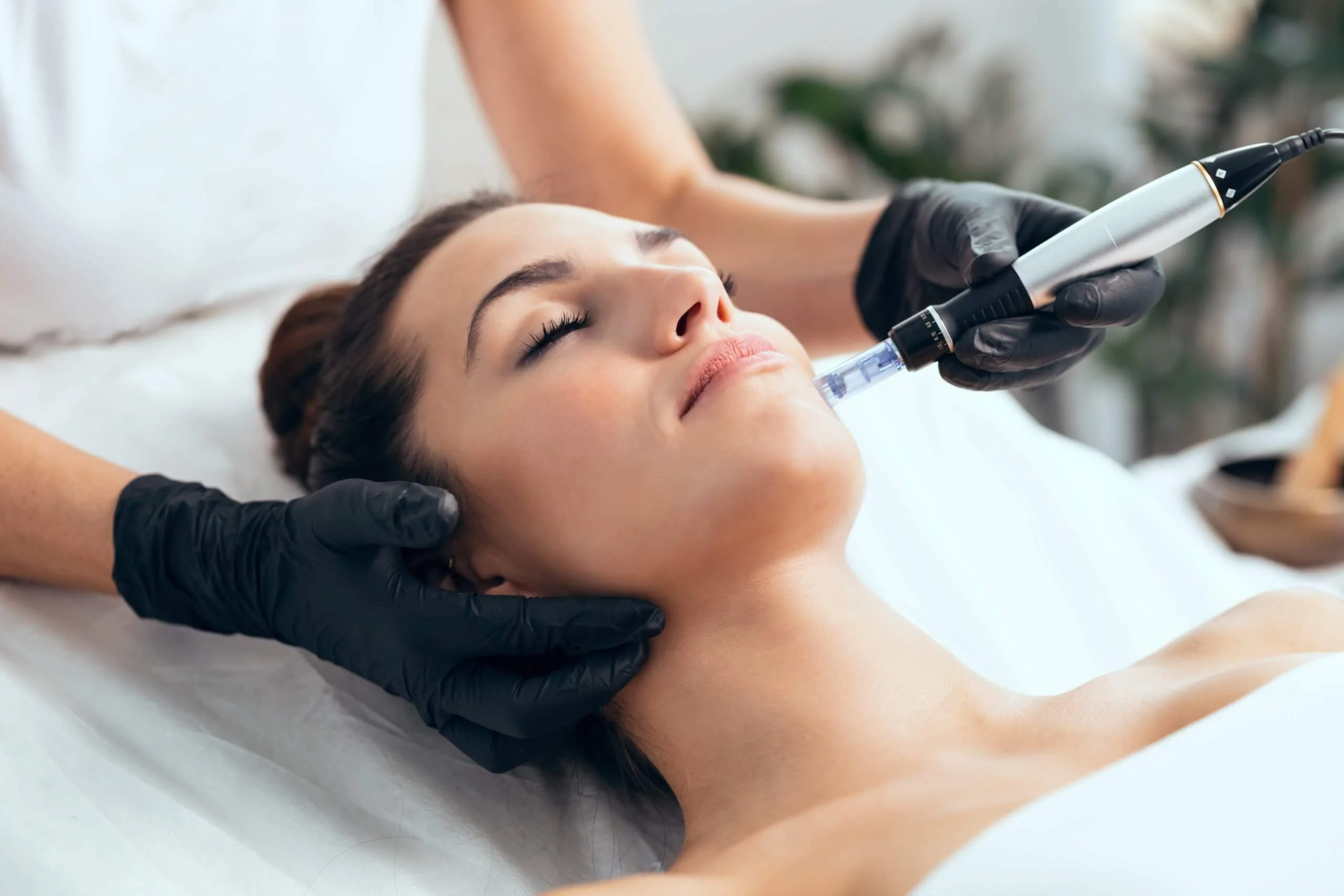 Microneedling in Ottawa