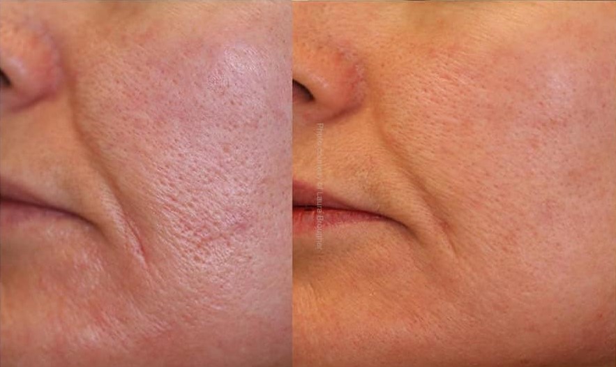 Laser Genesis in Ottawa