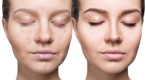 Microneedling with PRP and Exosomes