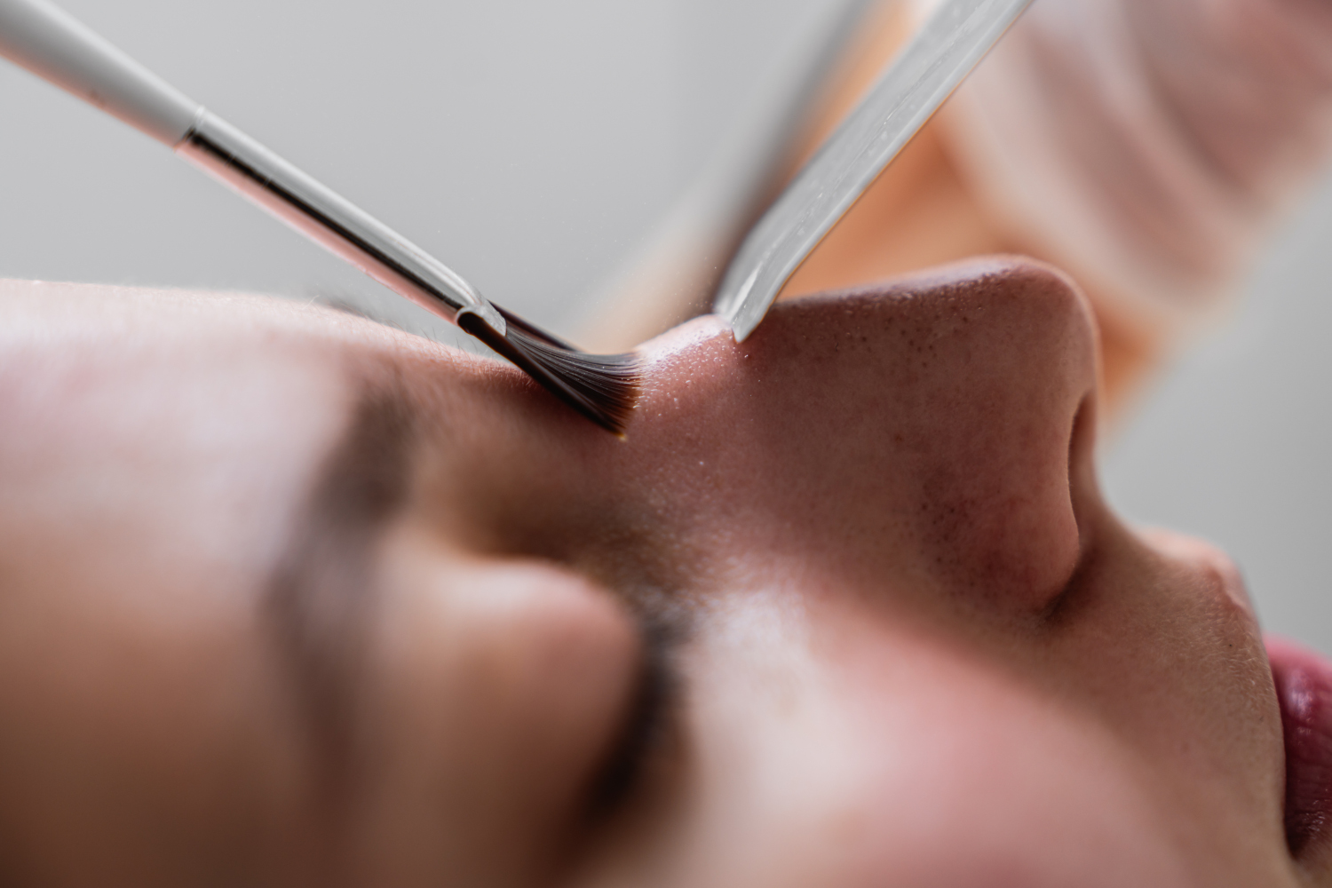 Struggling with Pigmentation Why Cosmelan Peel in Ottawa Is the Gold Standard for Clear Skin