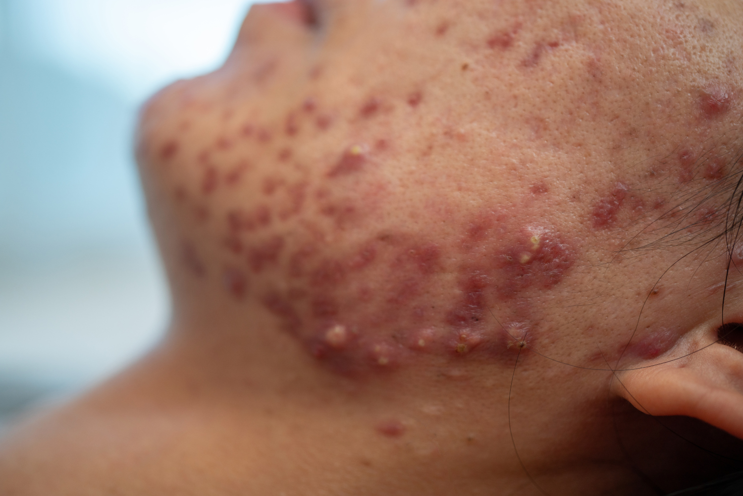 Acne Isn't Just for Teenagers Understanding Adult Acne and Modern Treatment Options in Ottawa