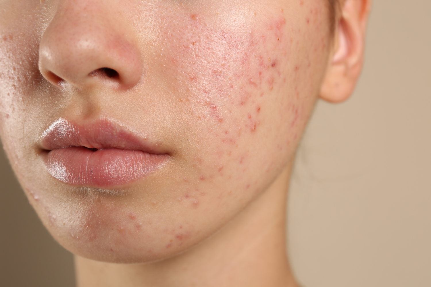 Why More Ottawa Clients Are Choosing Aerolase Neo Elite® for Acne, Pigmentation, and Skin Rejuvenation
